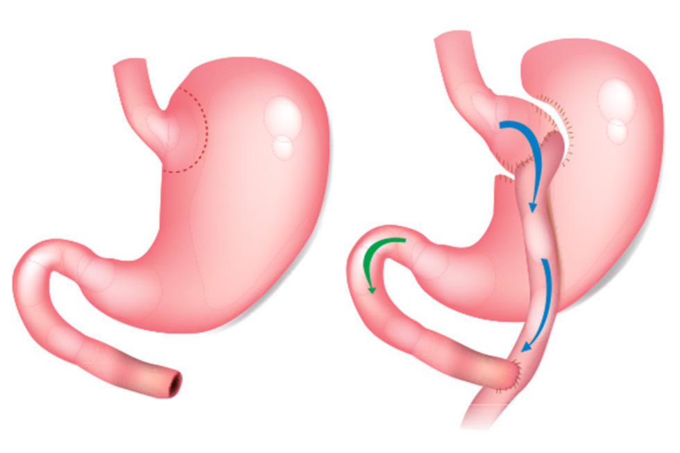 Bypass gastrique avant après : guide complet sur la chirurgie d’amaigrissement