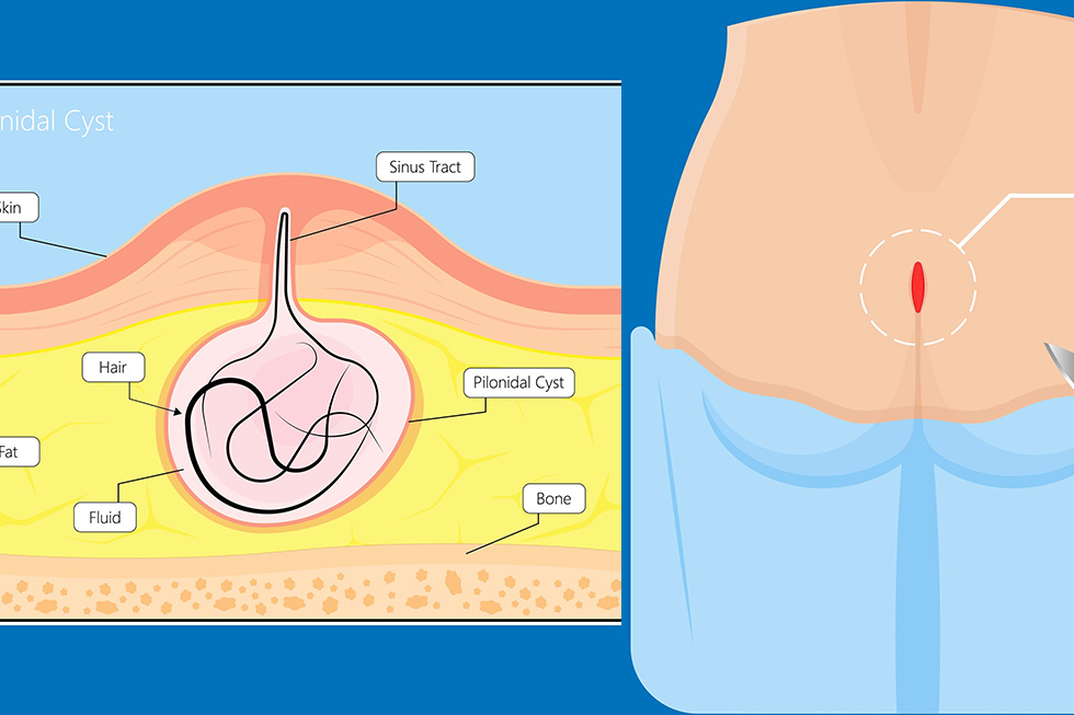 Cicatrisation du kyste pilonidal : Tout ce qu’il faut savoir après l’opération